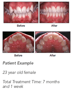 Accelerated Osteogenic Orthodontics Accelerated Osteogenic Orthodontics